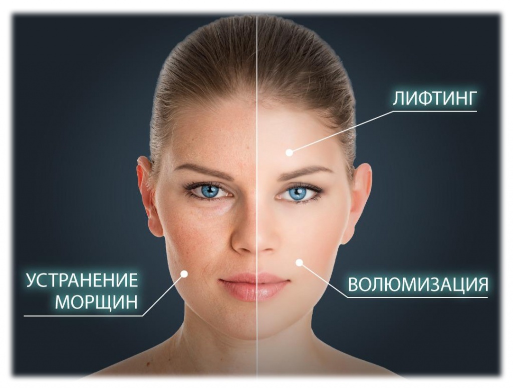 &nbsp;Микроигольчатый&nbsp;RF Лифтинг для омоложения